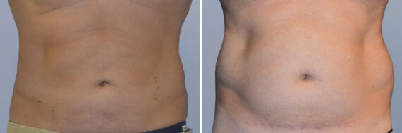Body Procedures before and after photos in FL, Palm Beach Gardens, Patient 1042