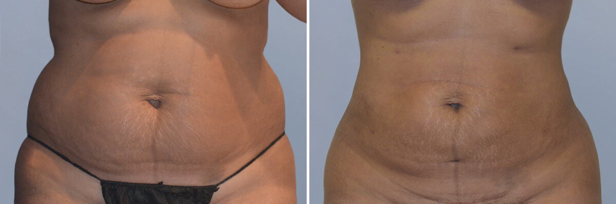 Body Procedures before and after photos in FL, Palm Beach Gardens, Patient 1047