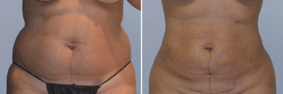 Body Procedures before and after photos in FL, Palm Beach Gardens, Patient 1047
