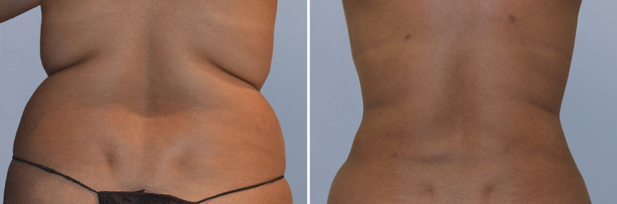 Body Procedures before and after photos in FL, Palm Beach Gardens, Patient 1047