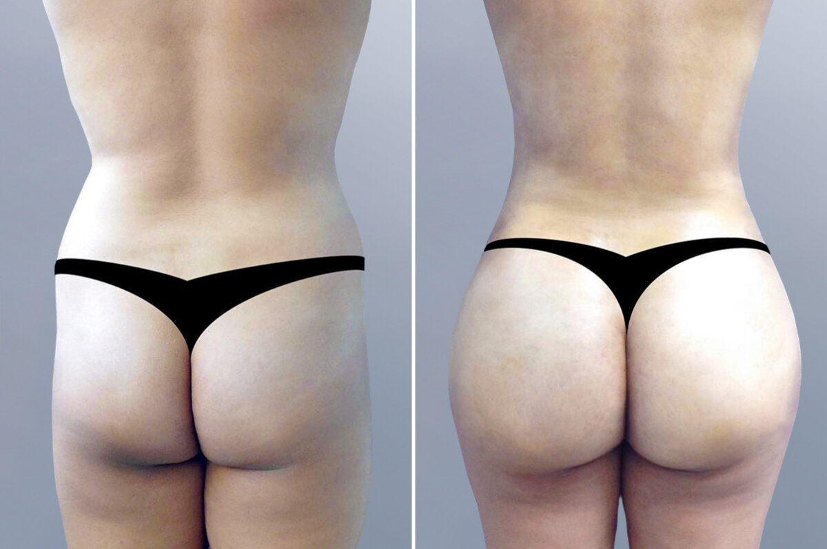 Body Procedures before and after photos in FL, Palm Beach Gardens, Patient 3622