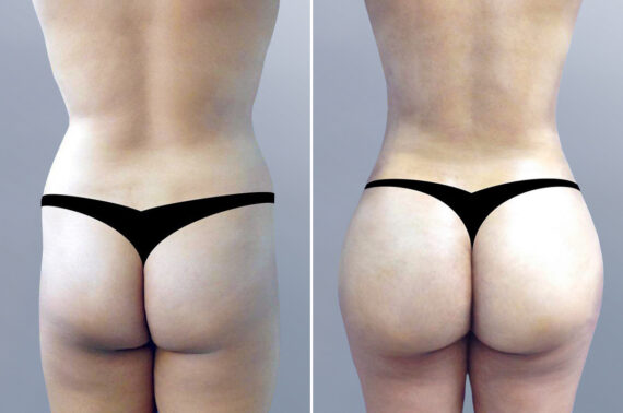 Body Procedures before and after photos in FL, Palm Beach Gardens, Patient 3622
