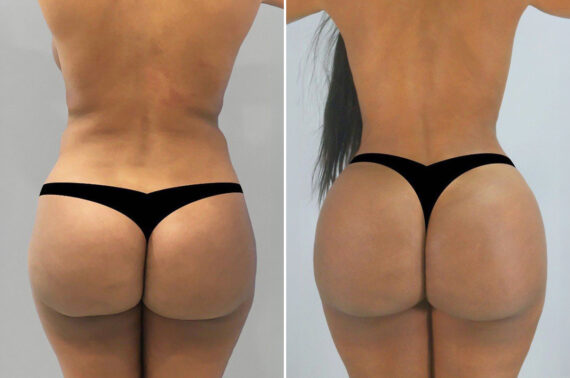 Body Procedures before and after photos in FL, Palm Beach Gardens, Patient 991