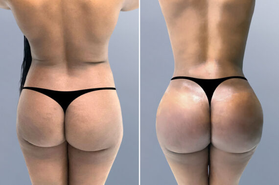 Body Procedures before and after photos in FL, Palm Beach Gardens, Patient 997