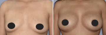 Breast Augmentation before and after photos in FL, Palm Beach Gardens, Patient 1009