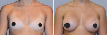 Breast Augmentation before and after photos in FL, Palm Beach Gardens, Patient 1012