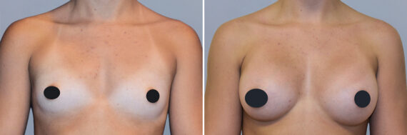Breast Augmentation before and after photos in FL, Palm Beach Gardens, Patient 1012
