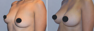 Breast Augmentation before and after photos in FL, Palm Beach Gardens, Patient 1015