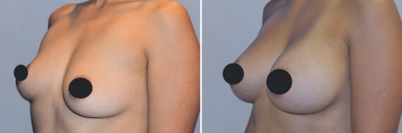 Breast Augmentation before and after photos in FL, Palm Beach Gardens, Patient 1015
