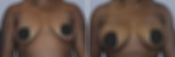 Breast Fat Transfer before and after photos in FL, Palm Beach Gardens, Patient 1018