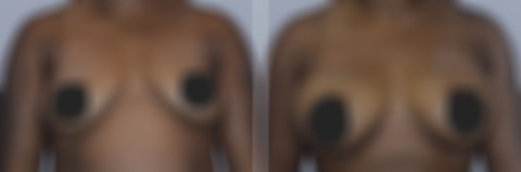 Breast Fat Transfer before and after photos in FL, Palm Beach Gardens, Patient 1018