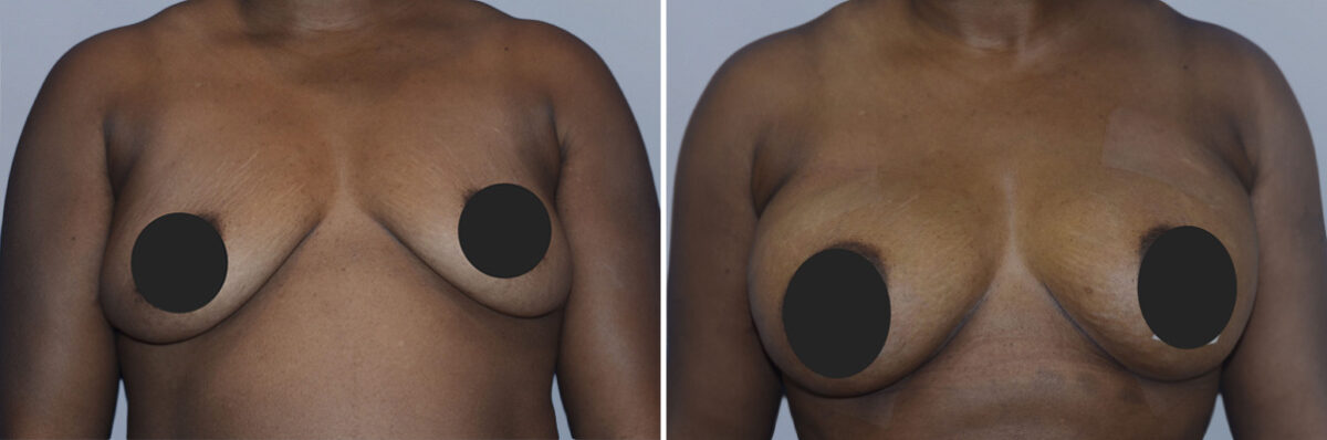Breast Fat Transfer before and after photos in FL, Palm Beach Gardens, Patient 1018