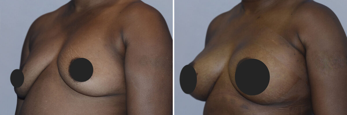 Breast Fat Transfer before and after photos in FL, Palm Beach Gardens, Patient 1018