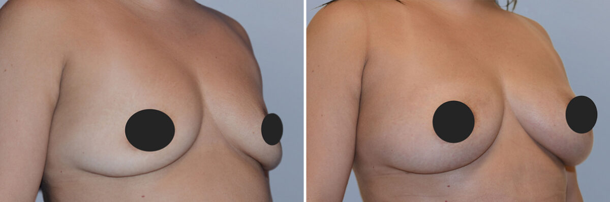 Breast Fat Transfer before and after photos in FL, Palm Beach Gardens, Patient 1023
