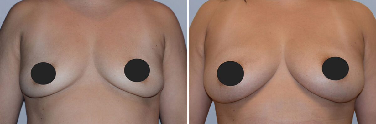 Breast Fat Transfer before and after photos in FL, Palm Beach Gardens, Patient 1023