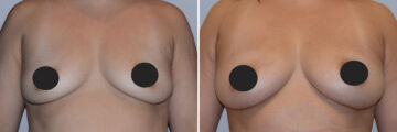 Breast Fat Transfer before and after photos in FL, Palm Beach Gardens, Patient 1023