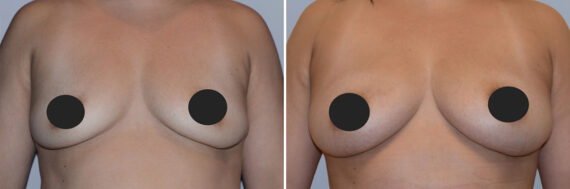 Breast Fat Transfer before and after photos in FL, Palm Beach Gardens, Patient 1023
