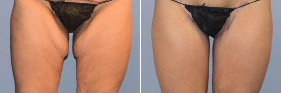 Body Procedures before and after photos in FL, Palm Beach Gardens, Patient 1052