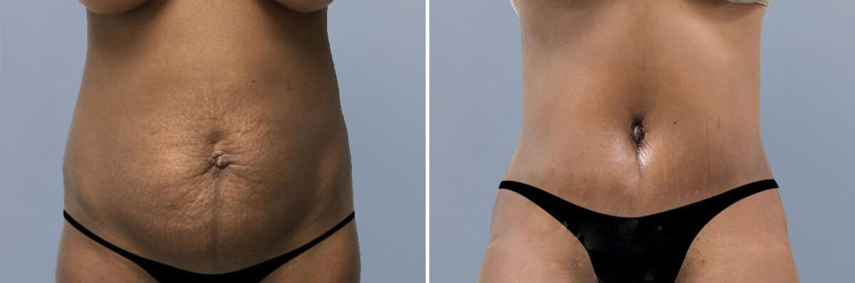 Body Procedures before and after photos in FL, Palm Beach Gardens, Patient 1055