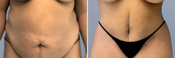 Body Procedures before and after photos in FL, Palm Beach Gardens, Patient 1058