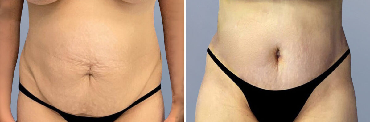 Body Procedures before and after photos in FL, Palm Beach Gardens, Patient 1061