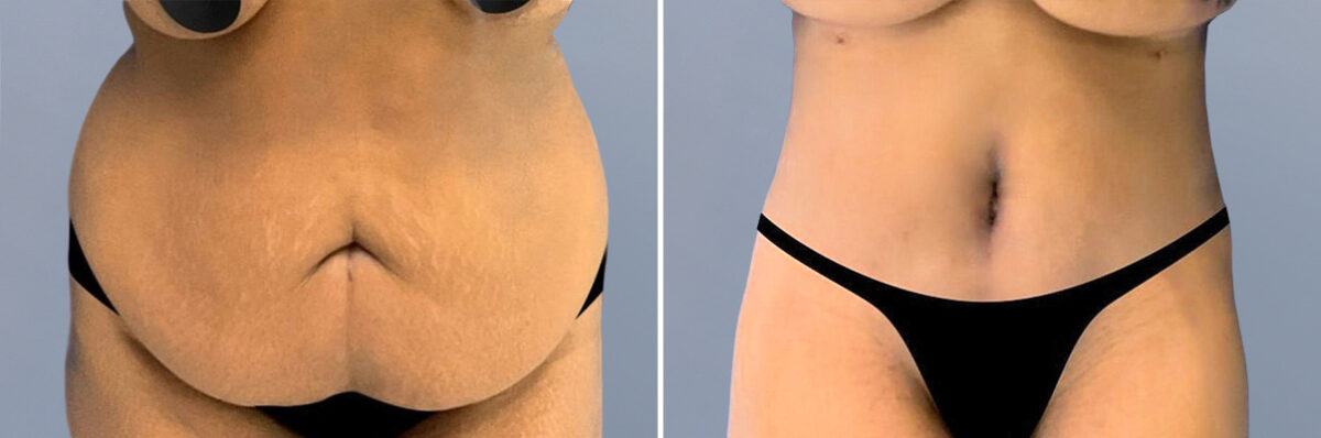 Body Procedures before and after photos in FL, Palm Beach Gardens, Patient 1064