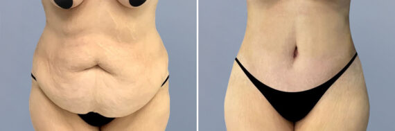 Body Procedures before and after photos in FL, Palm Beach Gardens, Patient 1067