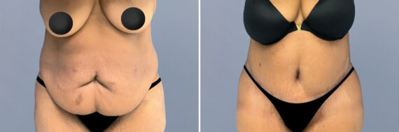 Body Procedures before and after photos in FL, Palm Beach Gardens, Patient 1070