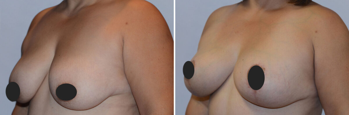 Breast Augmentation and Lift before and after photos in FL, Palm Beach Gardens, Patient 1073