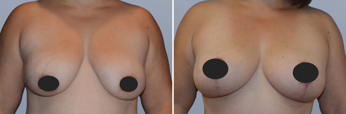 Breast Augmentation and Lift before and after photos in FL, Palm Beach Gardens, Patient 1073