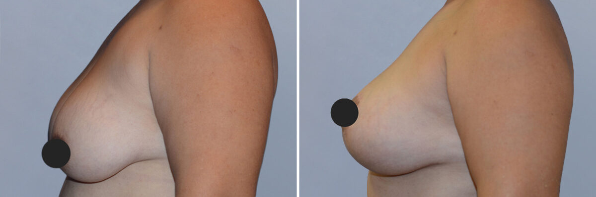 Breast Augmentation and Lift before and after photos in FL, Palm Beach Gardens, Patient 1073