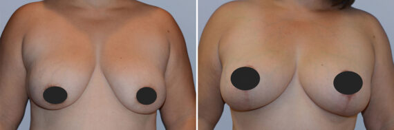 Breast Procedures before and after photos in FL, Palm Beach Gardens