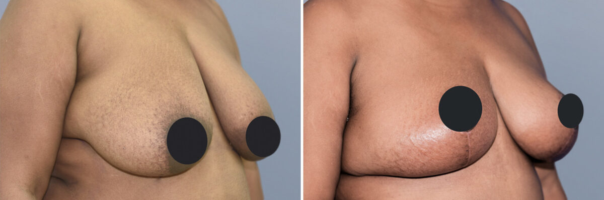Breast Lift (Mastopexy) before and after photos in FL, Palm Beach Gardens, Patient 1080