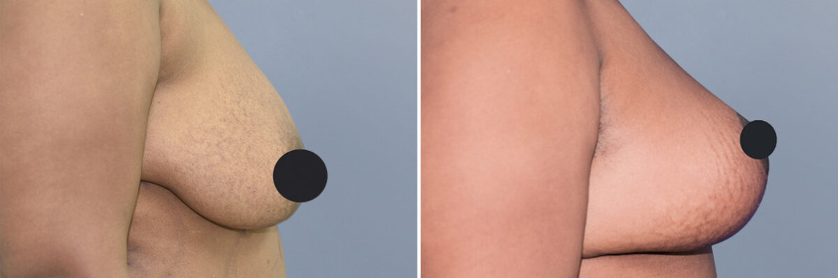 Breast Lift (Mastopexy) before and after photos in FL, Palm Beach Gardens, Patient 1080
