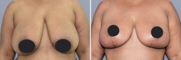 Breast Lift (Mastopexy) before and after photos in FL, Palm Beach Gardens, Patient 1080