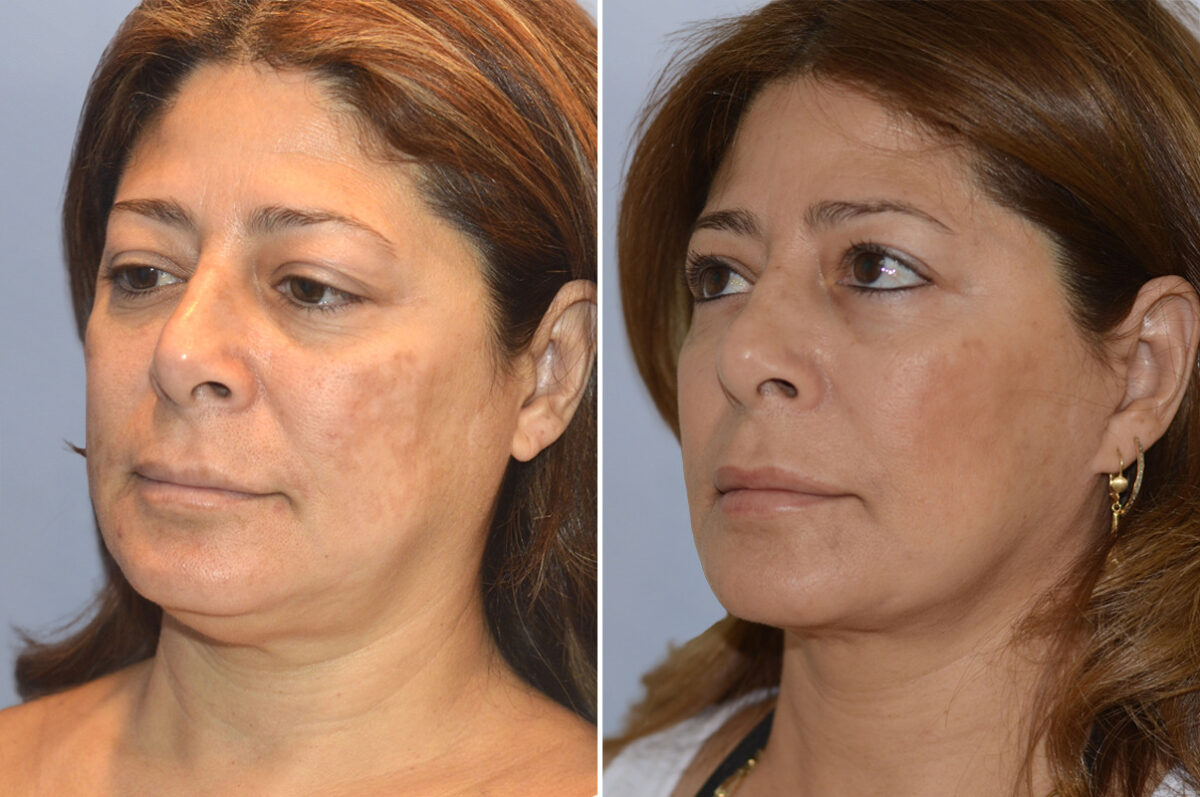 Face Procedures before and after photos in FL, Palm Beach Gardens, Patient 1087