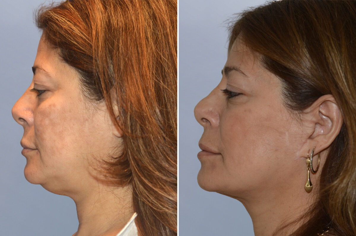 Face Procedures before and after photos in FL, Palm Beach Gardens, Patient 1087