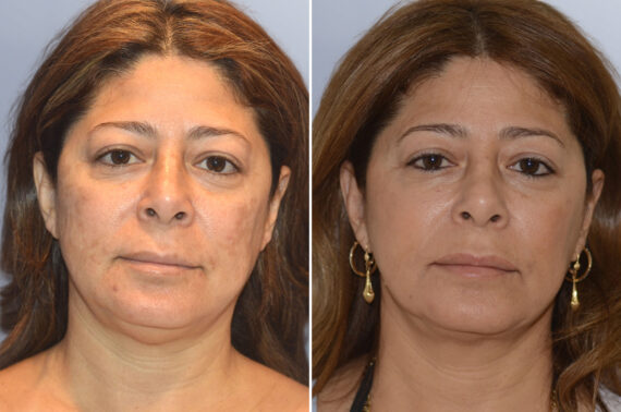 Face Procedures before and after photos in FL, Palm Beach Gardens