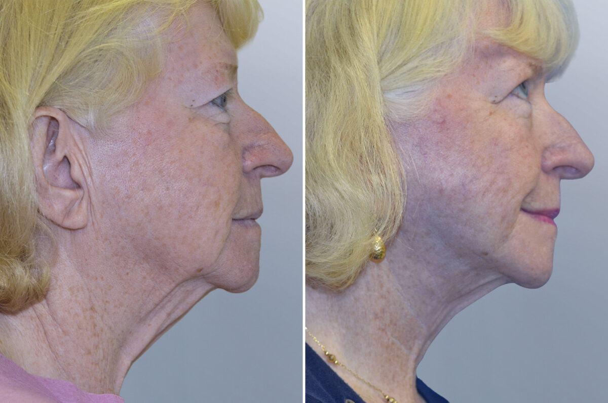 Face Procedures before and after photos in FL, Palm Beach Gardens, Patient 1094