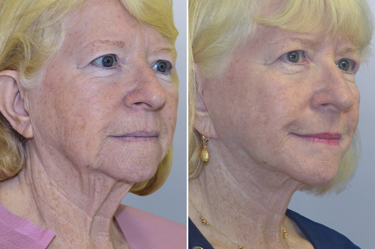 Face Procedures before and after photos in FL, Palm Beach Gardens, Patient 1094