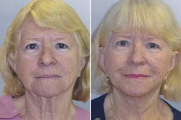 Face Procedures before and after photos in FL, Palm Beach Gardens, Patient 1094