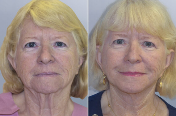 Face Procedures before and after photos in FL, Palm Beach Gardens, Patient 1094