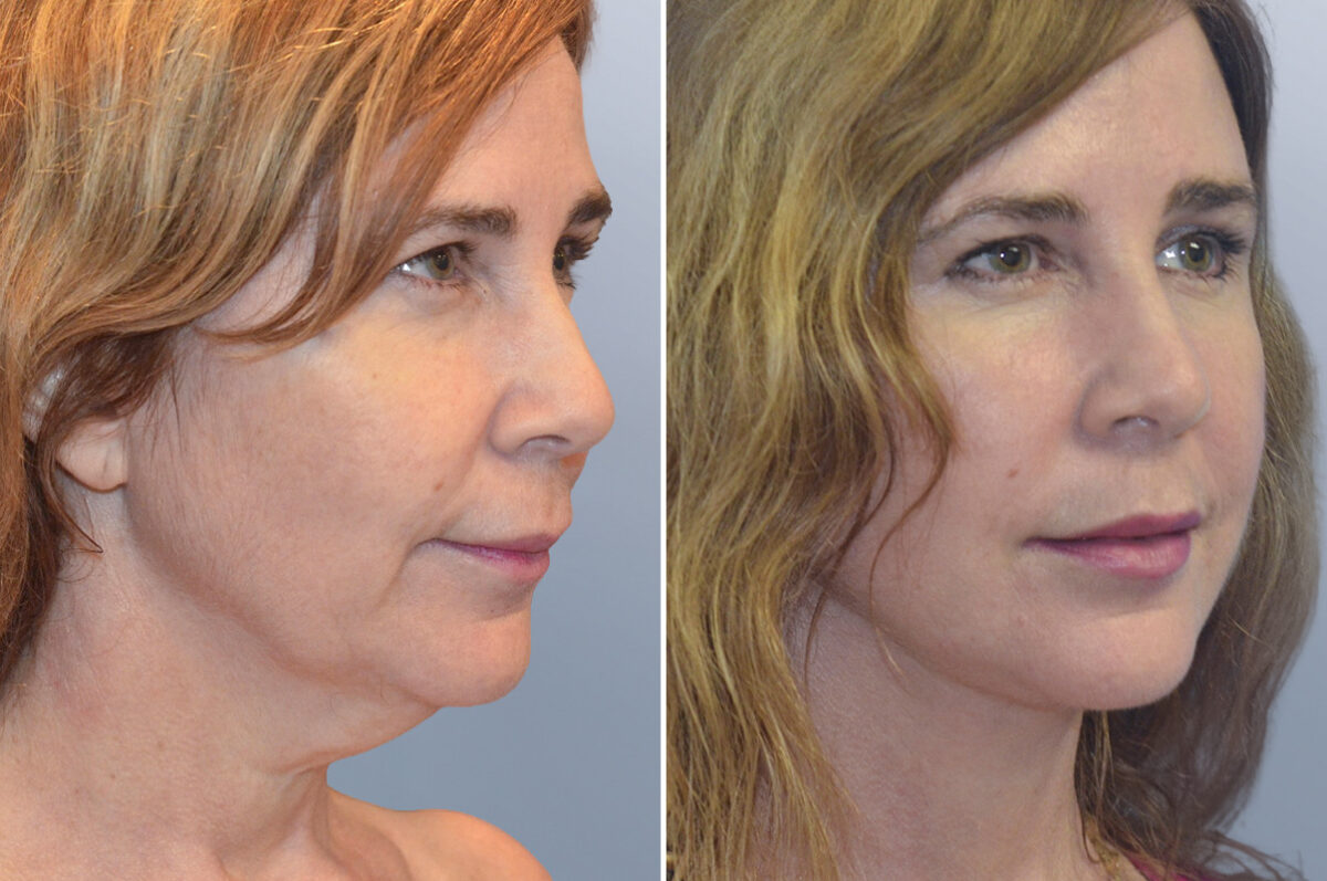 Face Procedures before and after photos in FL, Palm Beach Gardens, Patient 1101