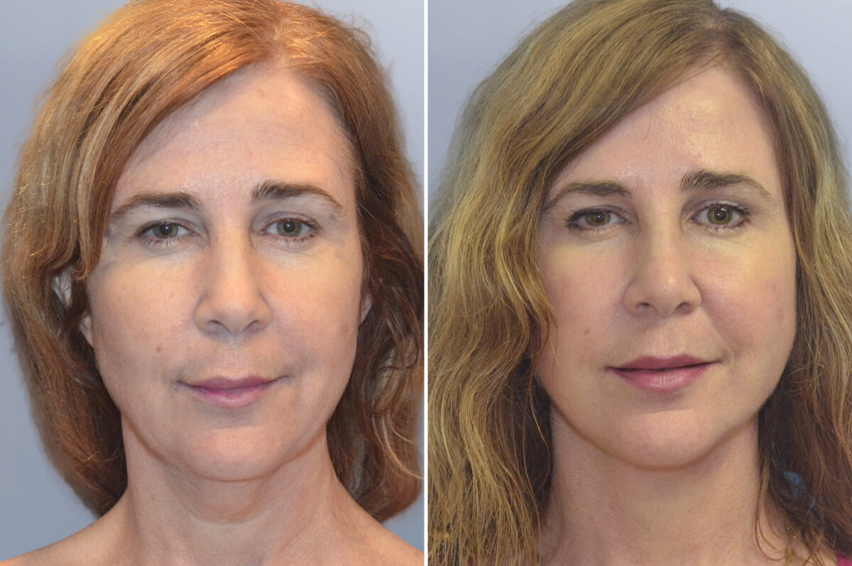 Face Procedures before and after photos in FL, Palm Beach Gardens, Patient 1101