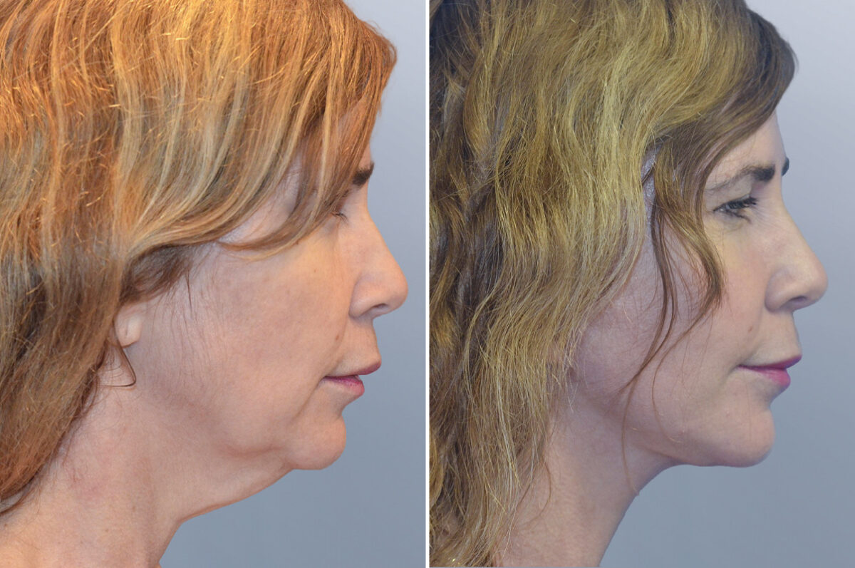 Face Procedures before and after photos in FL, Palm Beach Gardens, Patient 1101