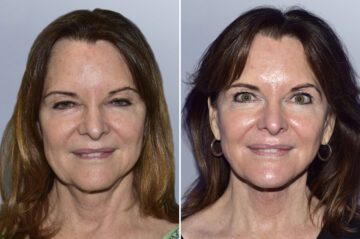 Face Procedures before and after photos in FL, Palm Beach Gardens, Patient 1108