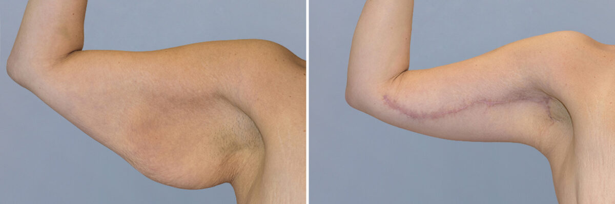 Body Procedures before and after photos in FL, Palm Beach Gardens, Patient 1111
