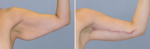 Body Procedures before and after photos in FL, Palm Beach Gardens, Patient 1111