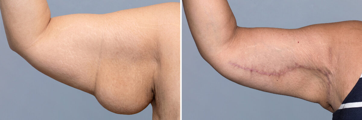 Body Procedures before and after photos in FL, Palm Beach Gardens, Patient 1116