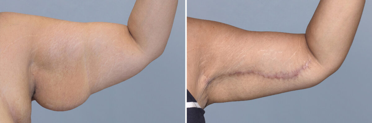Body Procedures before and after photos in FL, Palm Beach Gardens, Patient 1116
